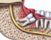 Wisdom Teeth Extraction Bala Cynwyd