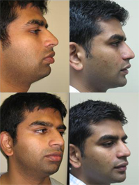 Facial Contouring Bala Cynwyd