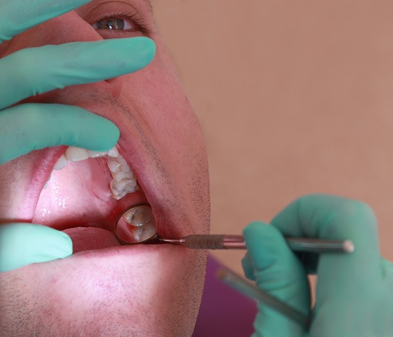 Wisdom Teeth Extraction Bala Cynwyd