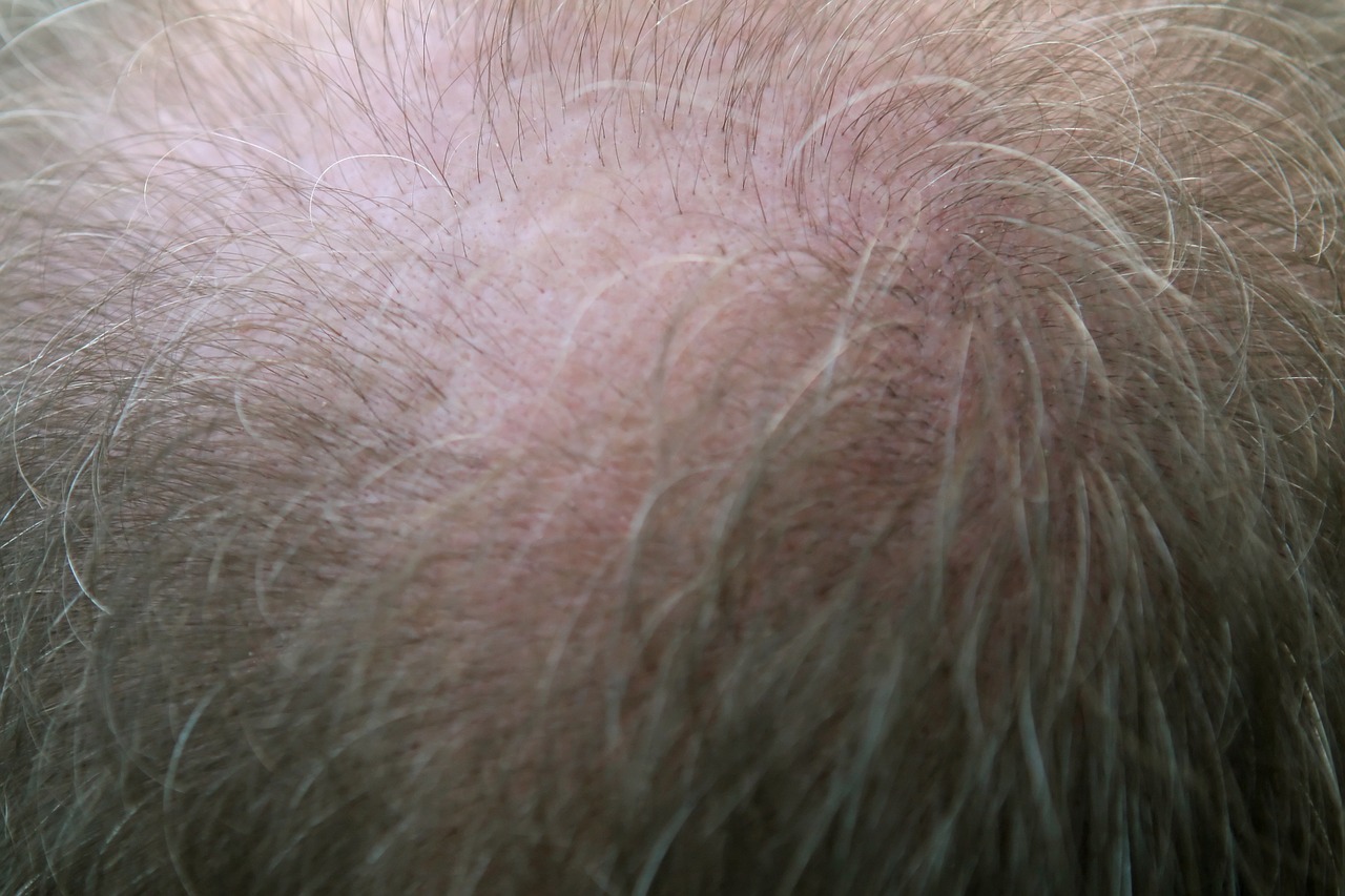 Hair Thinning Treatment Bala Cynwyd, PA
