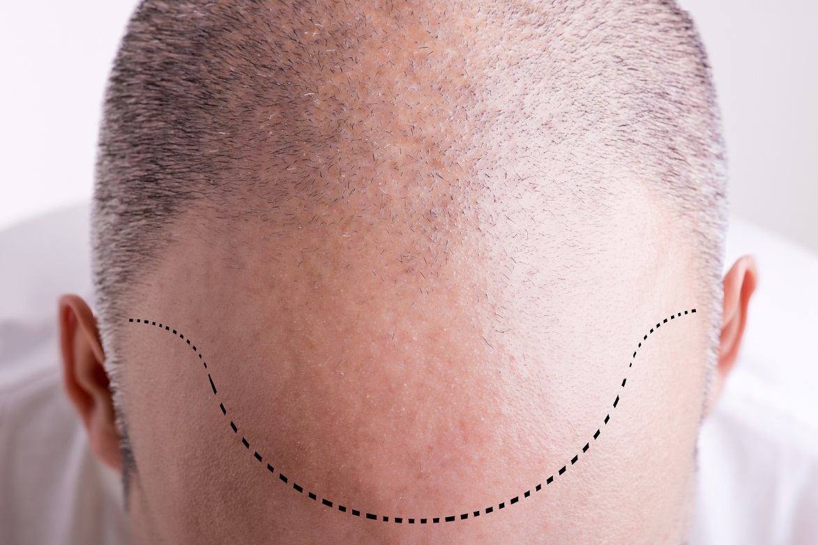 Hair Line restoration Bala Cynwyd, PA