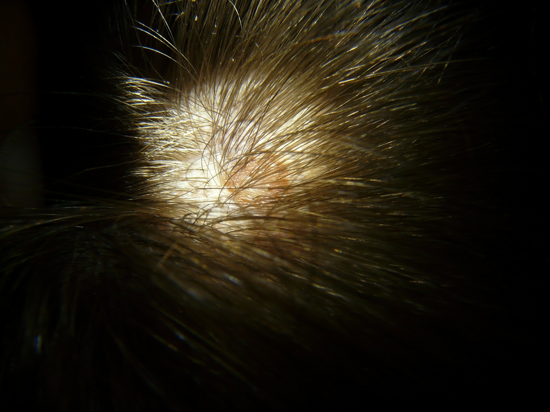 Scalp Hair Transplant Bala Cynwyd
