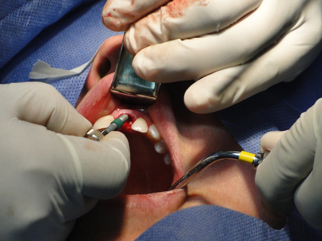 Dental Implant Surgery Bala Cynwyd