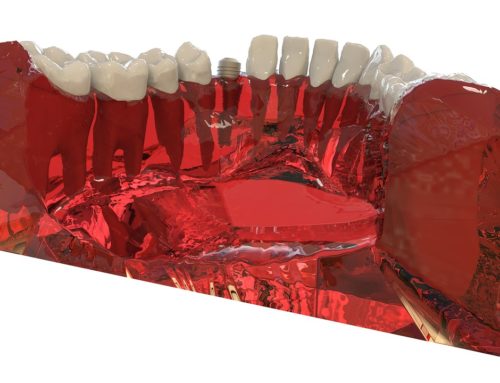 Can Anyone Get Dental Implants?