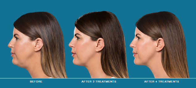 Kybella Treatment Bala Cynwyd