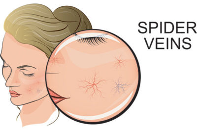 Facial Veins Treatment Bala Cynwyd
