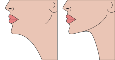 Jawline Contouring with Liposuction & Skin Tightening Bala Cynwyd