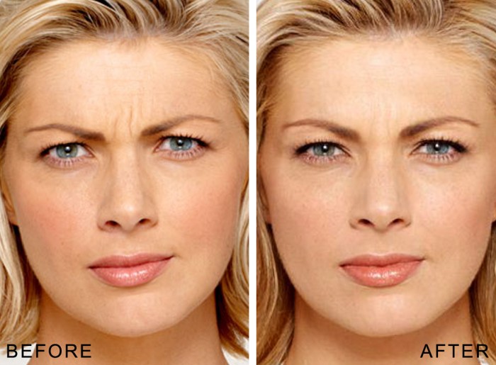 Botox Before & After Bala Cynwyd