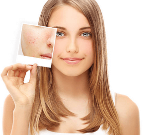 acne scars bala cynwyd