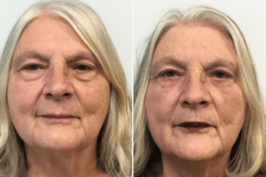 Blepharoplasty Bala Cynwyd