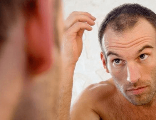 What is a FUE Hair Transplant?