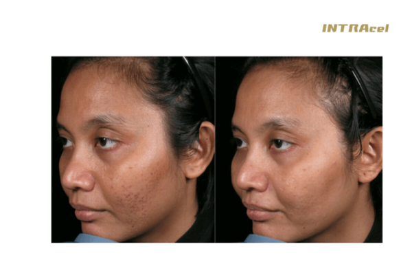 Intracel Fractional RF Microneedling Bala Cynwyd