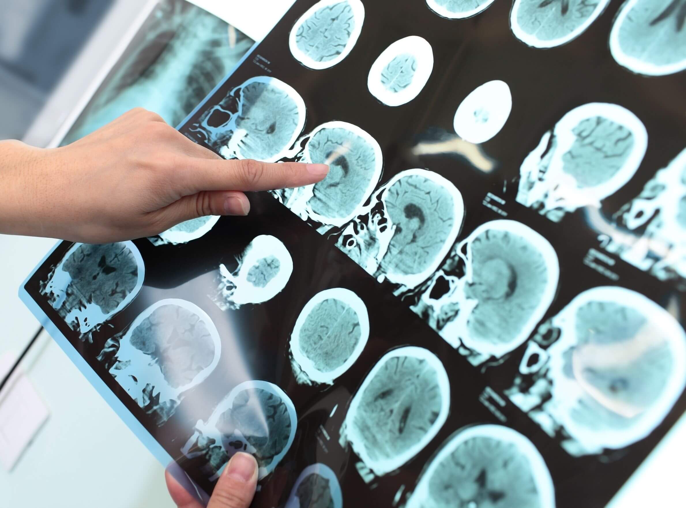 Brain Injuries At Work