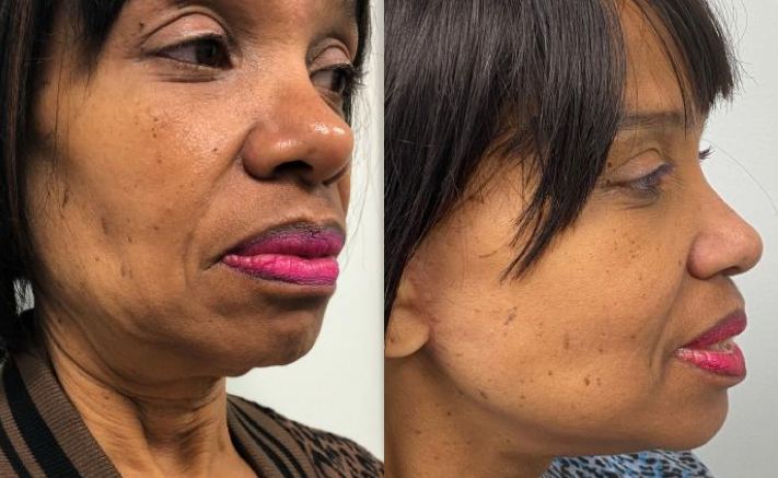 Facelift Bala Cynwyd