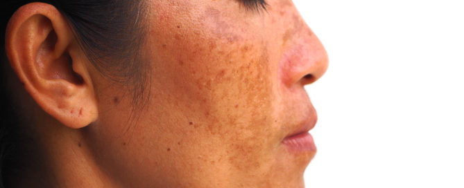 Sun Damage Bala Cynwyd