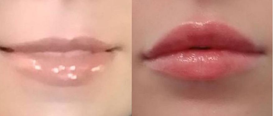 Dermal Fillers Bala Cynwyd