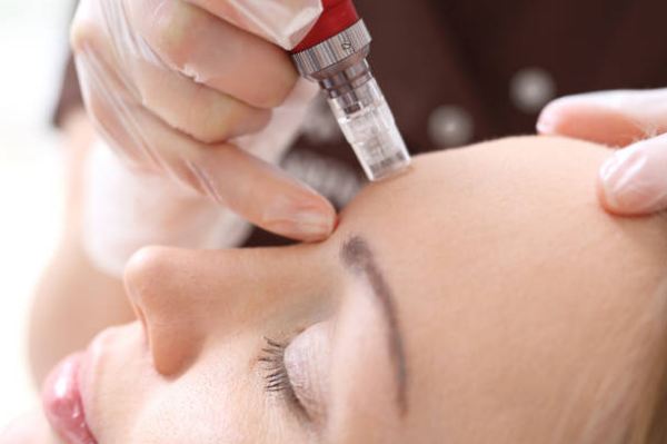 Microneedling Bala Cynwyd