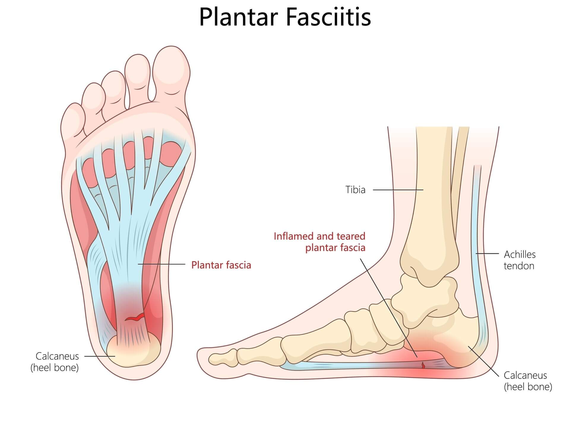 plantar fasciitis workers' comp